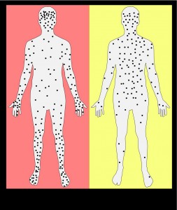 smallpox_versus_chickenpox_neutral_plain-svg-1000-x-1183